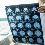 Long-Term Effects of TBIs and Their Impact on Injury Settlements